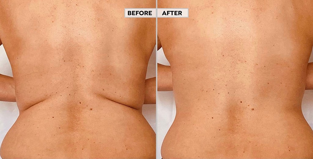 Mesotheraphy Body Treatment